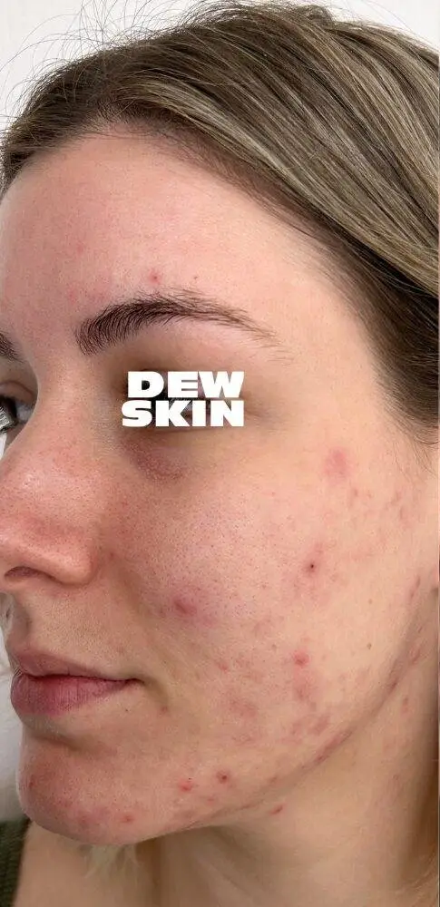 Active acne clearing before