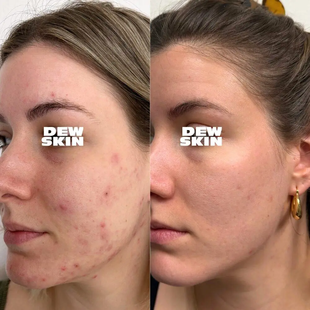 Active acne treatment result 1