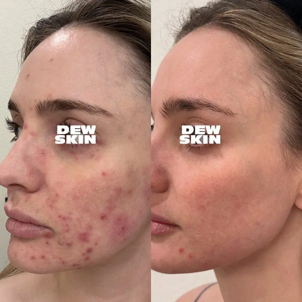Active acne treatment result 2