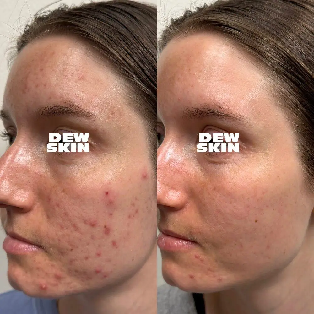 Active acne treatment result 3