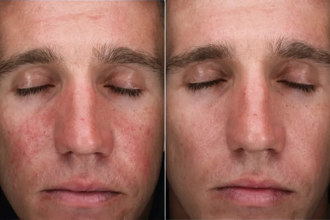 Skin Better AlphaRet Peel before and after