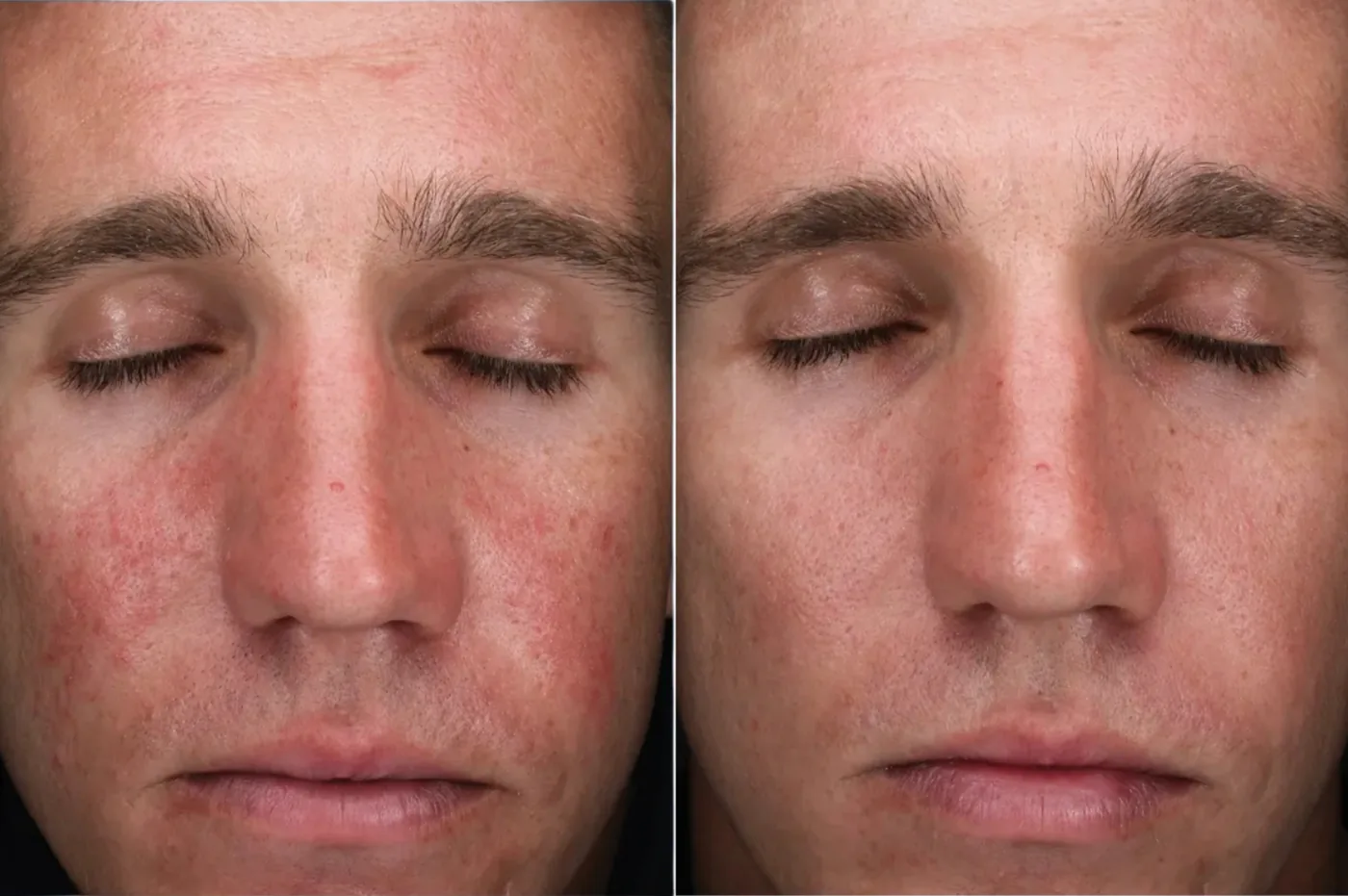 Skin Better AlphaRet Peel before and after