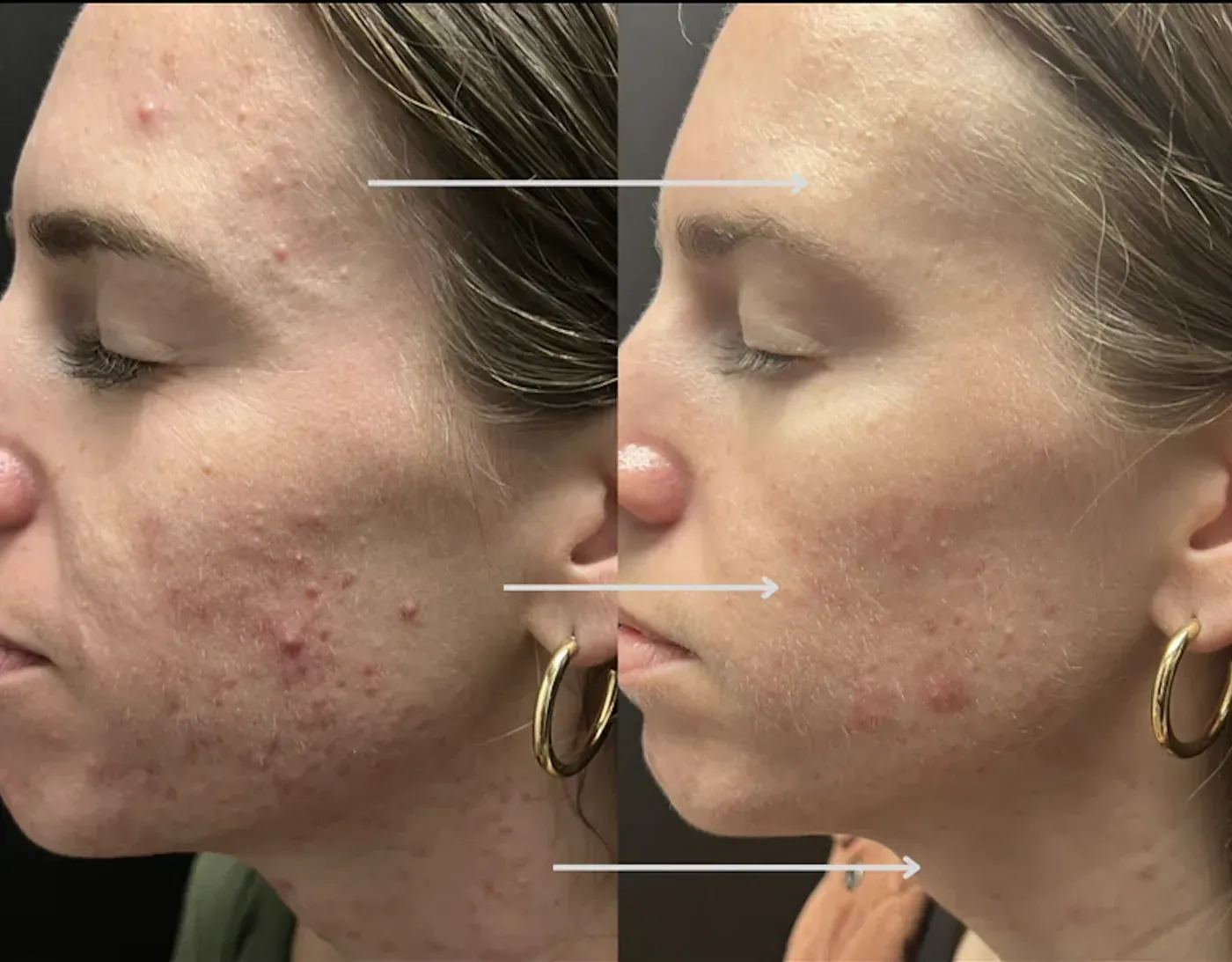 The Dew Double Peel before and after