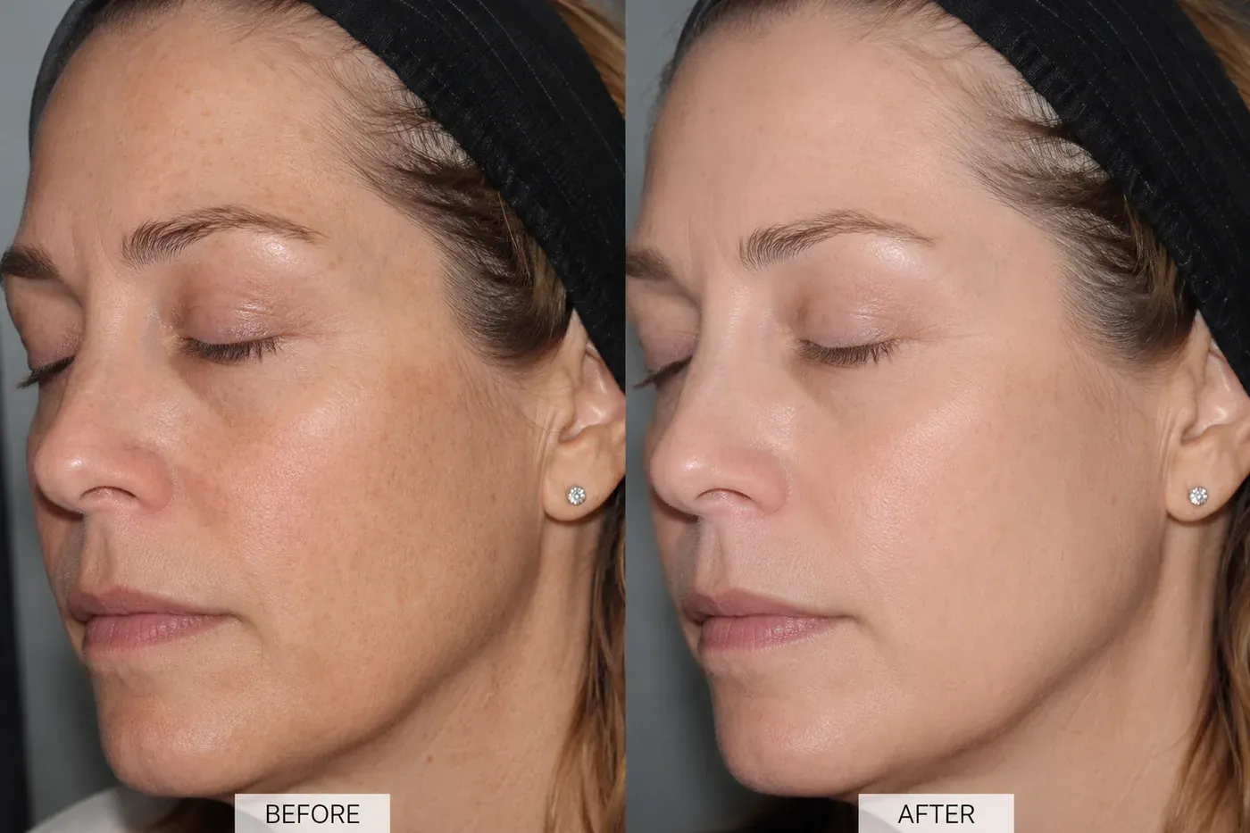 Factor Five Peel before and after