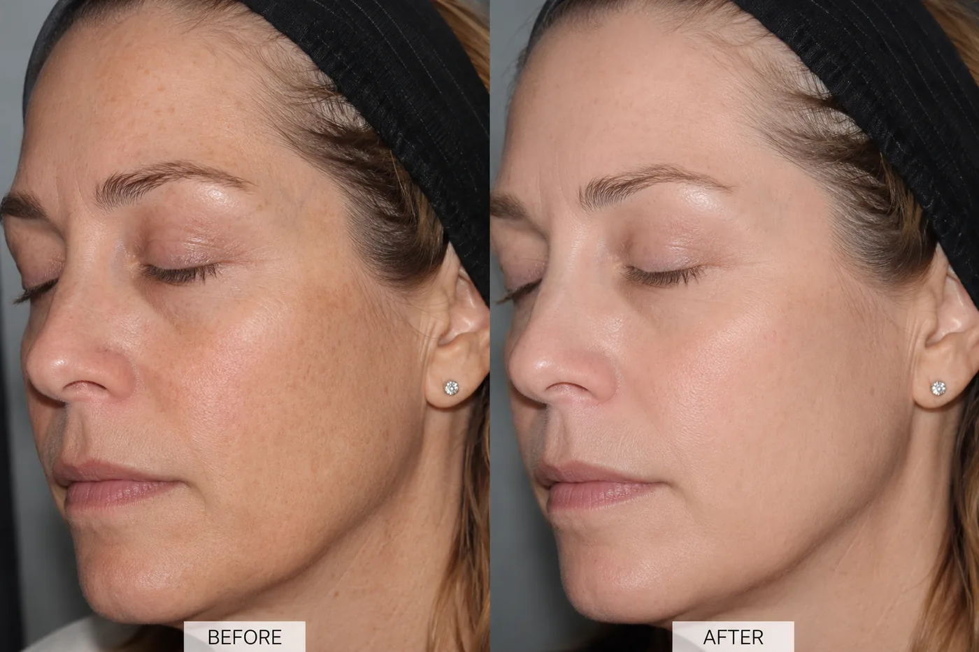 Factor Five Peel before and after