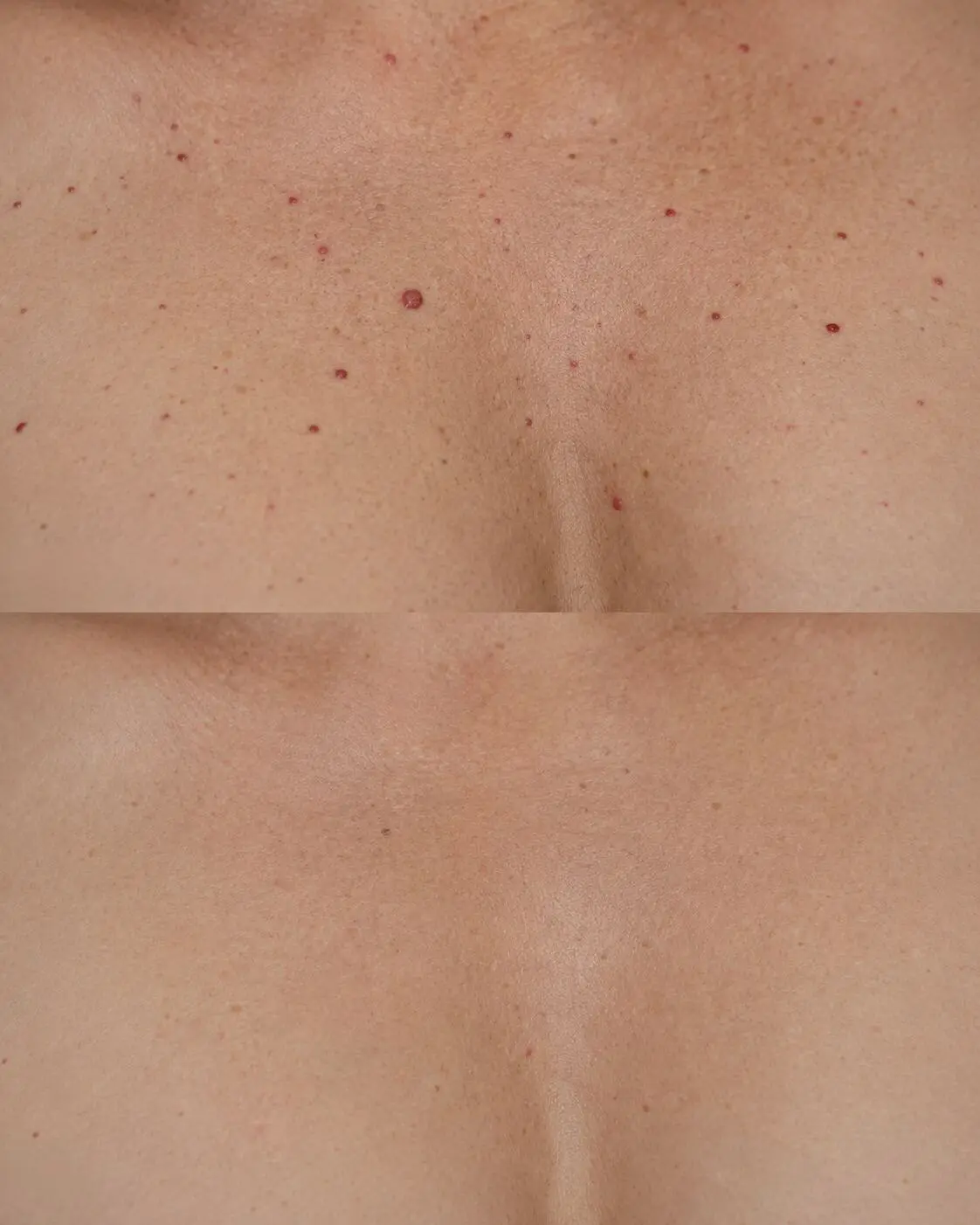 Leg veins treatment result 3