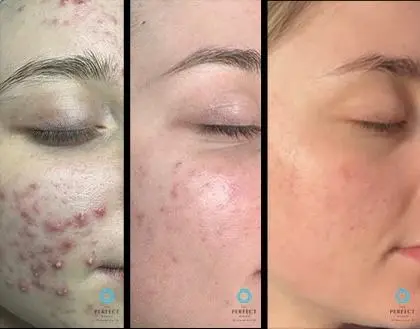 Perfect Derma™ Peel before and after