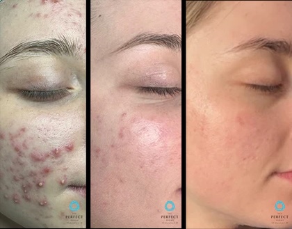 Perfect Derma™ Peel before and after