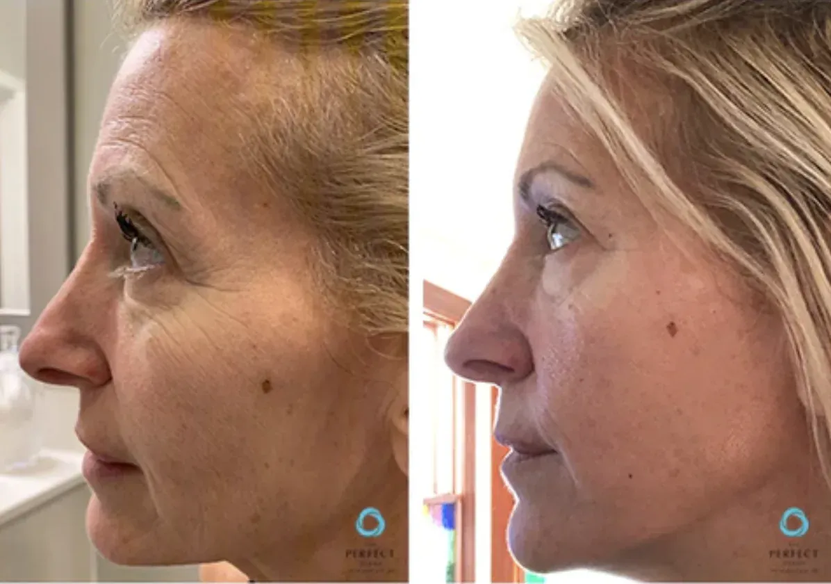 Pro Clinical Peel by Perfect Derma™ before and after
