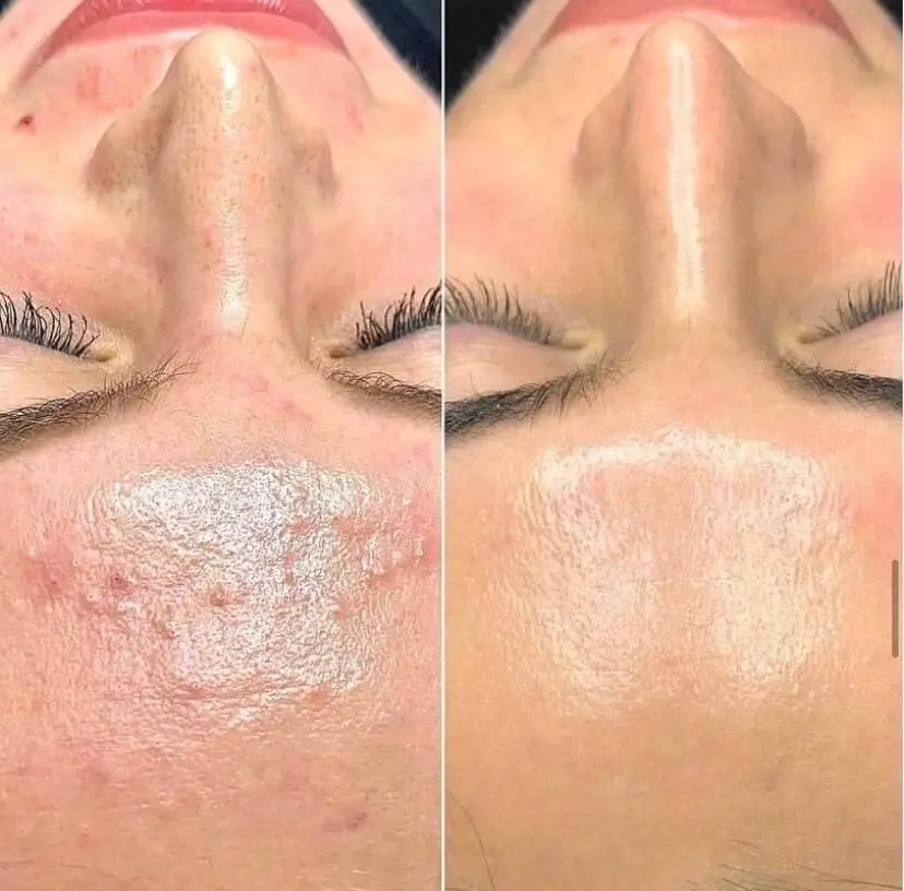 Dewskin laser facial before and after result 1