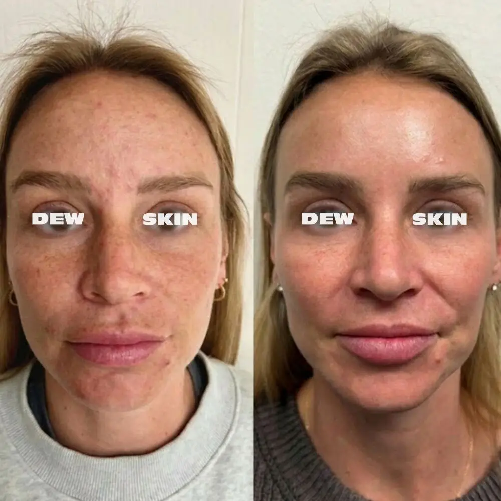 Dewskin laser facial before and after result 2