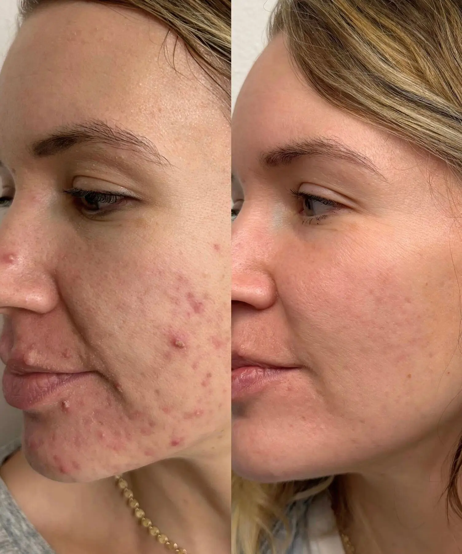 Microneedling result 3