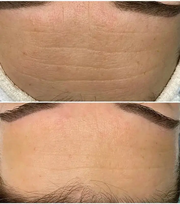 Dewskin laser facial before and after result 3