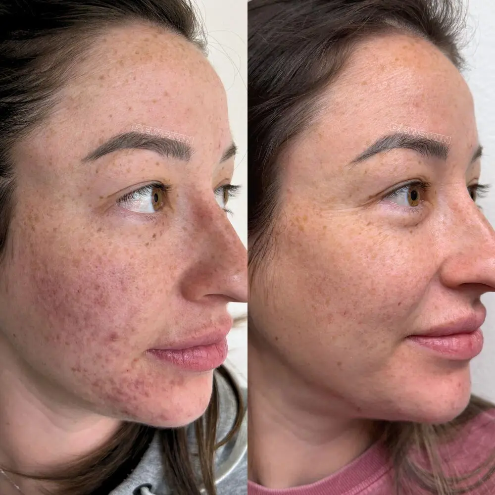 Microneedling result 4