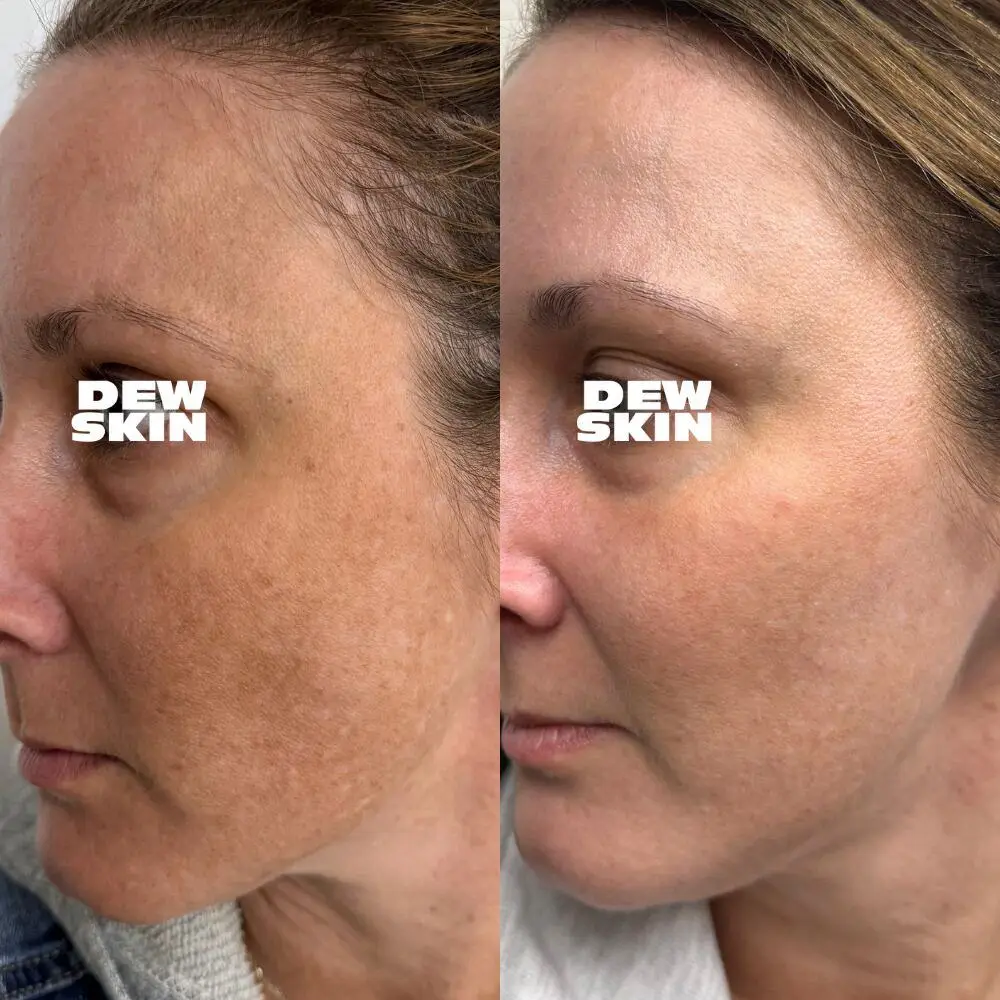 Dewskin laser facial before and after result 4