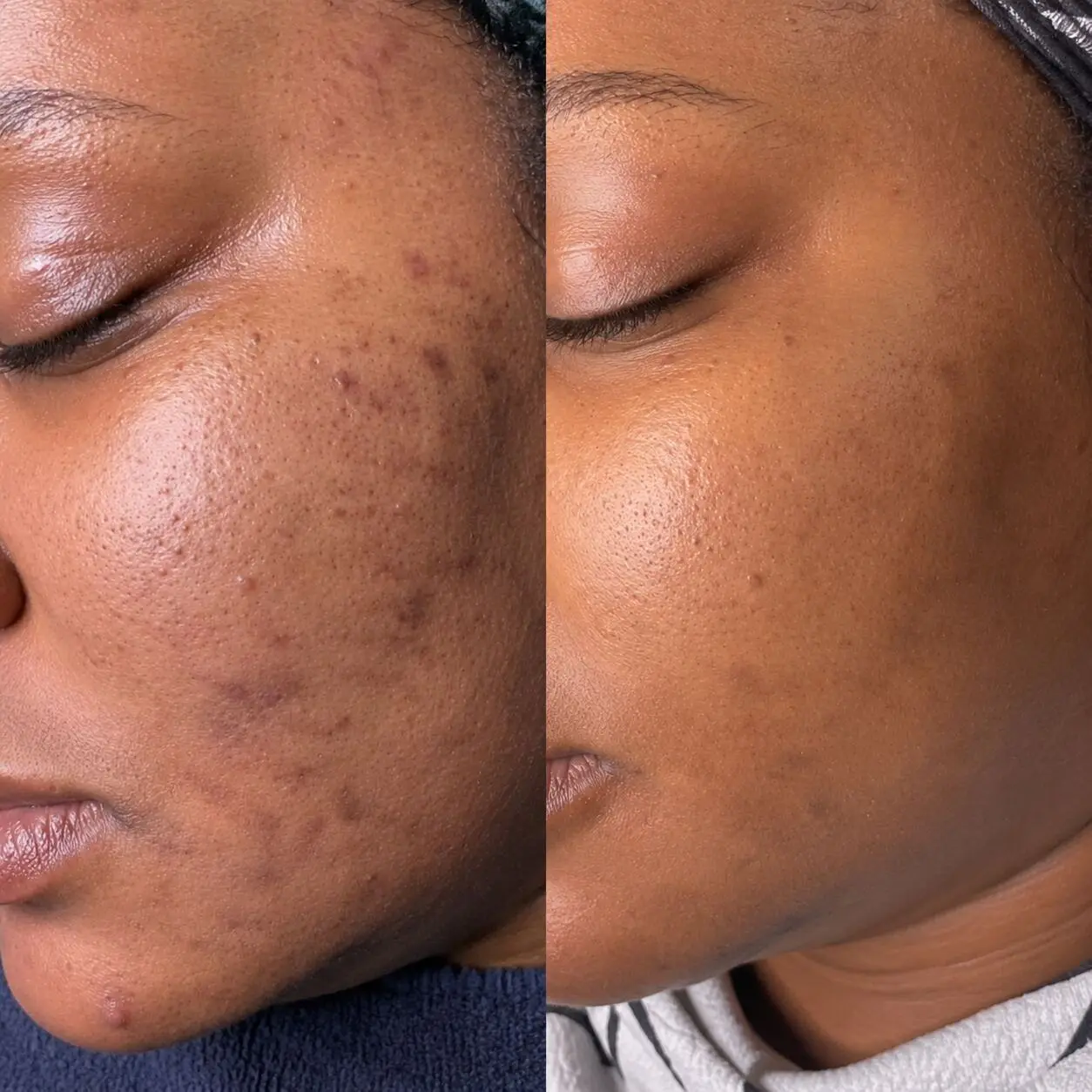Dewskin laser facial before and after result 5