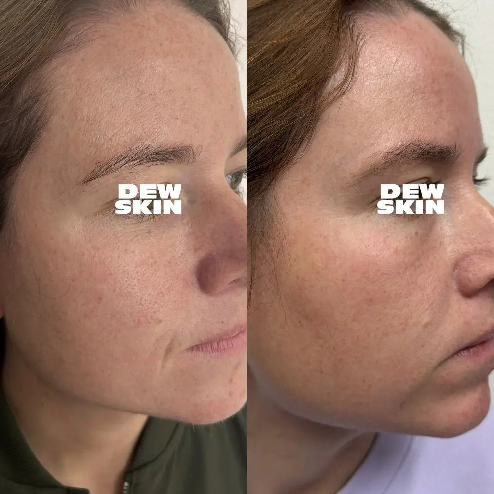 Dewskin laser facial before and after result 6