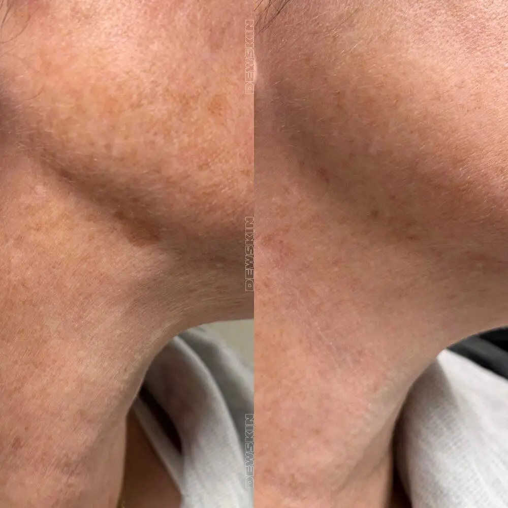 Spot treatment result 1