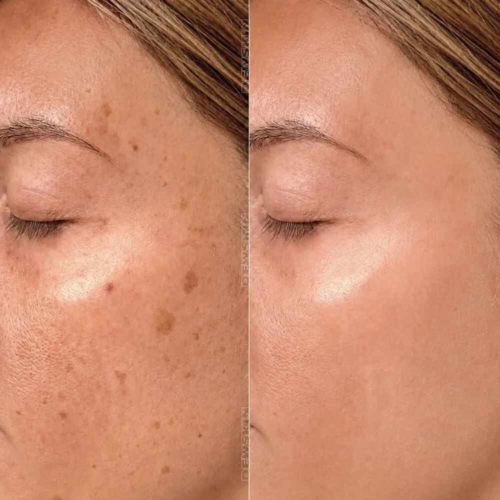 Spot treatment result 2