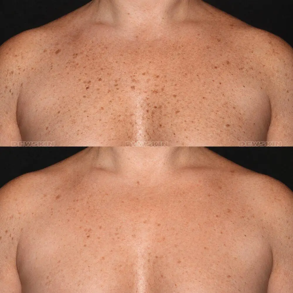 Spot treatment result 3