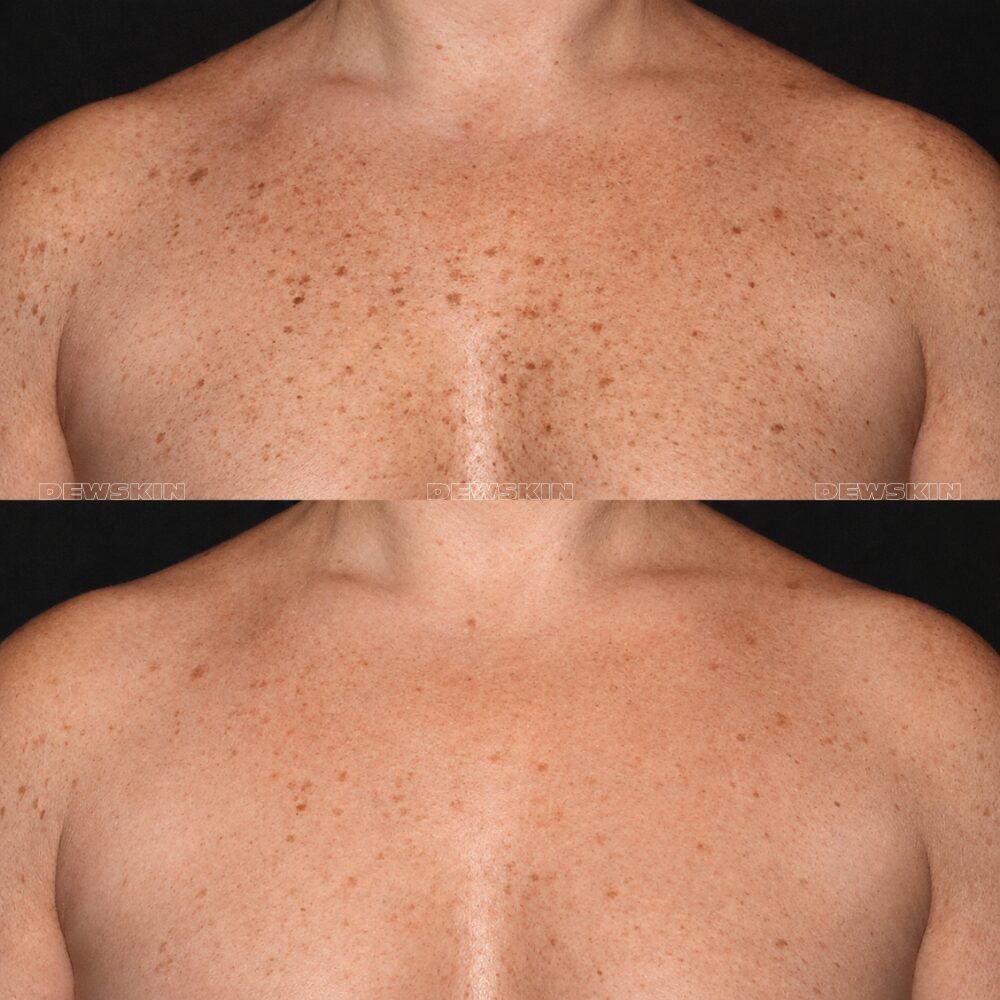 Spot treatment result 3