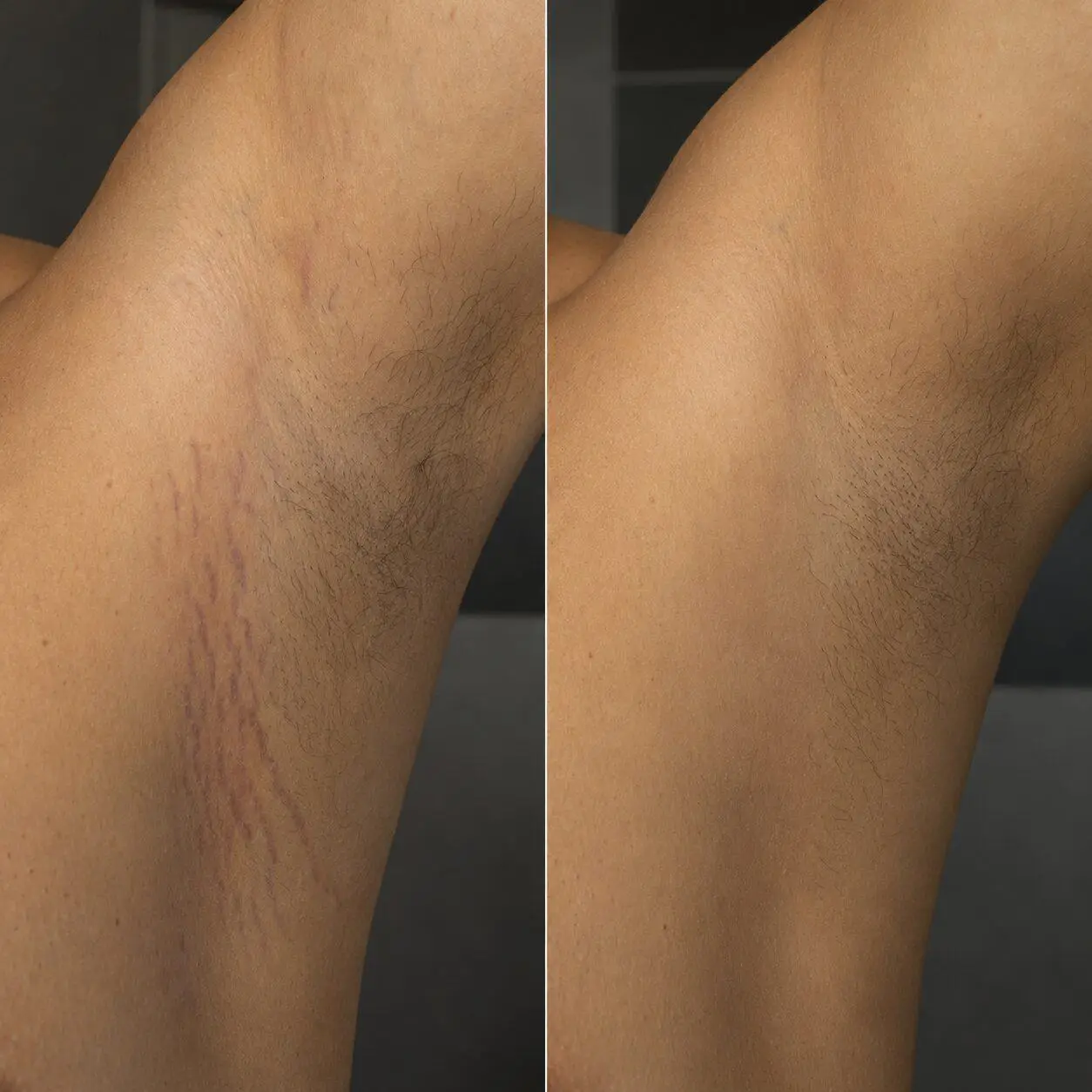 Stretch mark treatment before and after 3