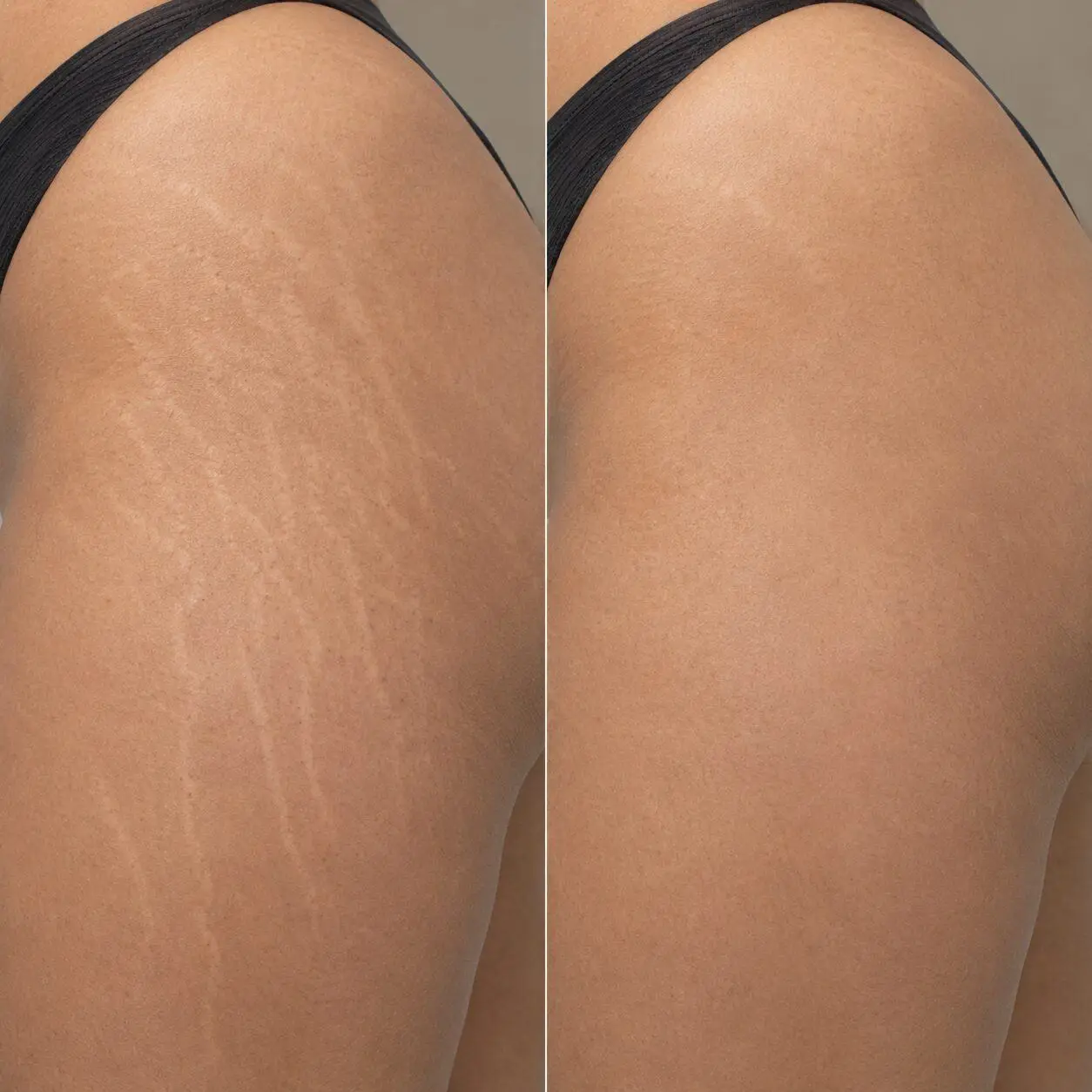 Stretch mark treatment before and after 1