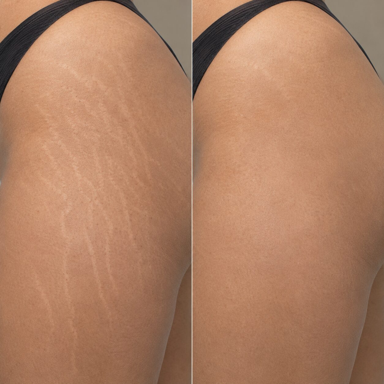 Stretch mark treatment before and after 1