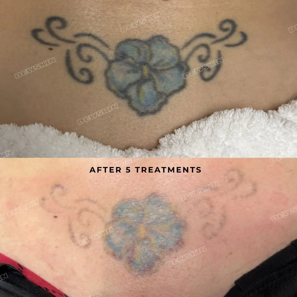 Tattoo removal before and after 2
