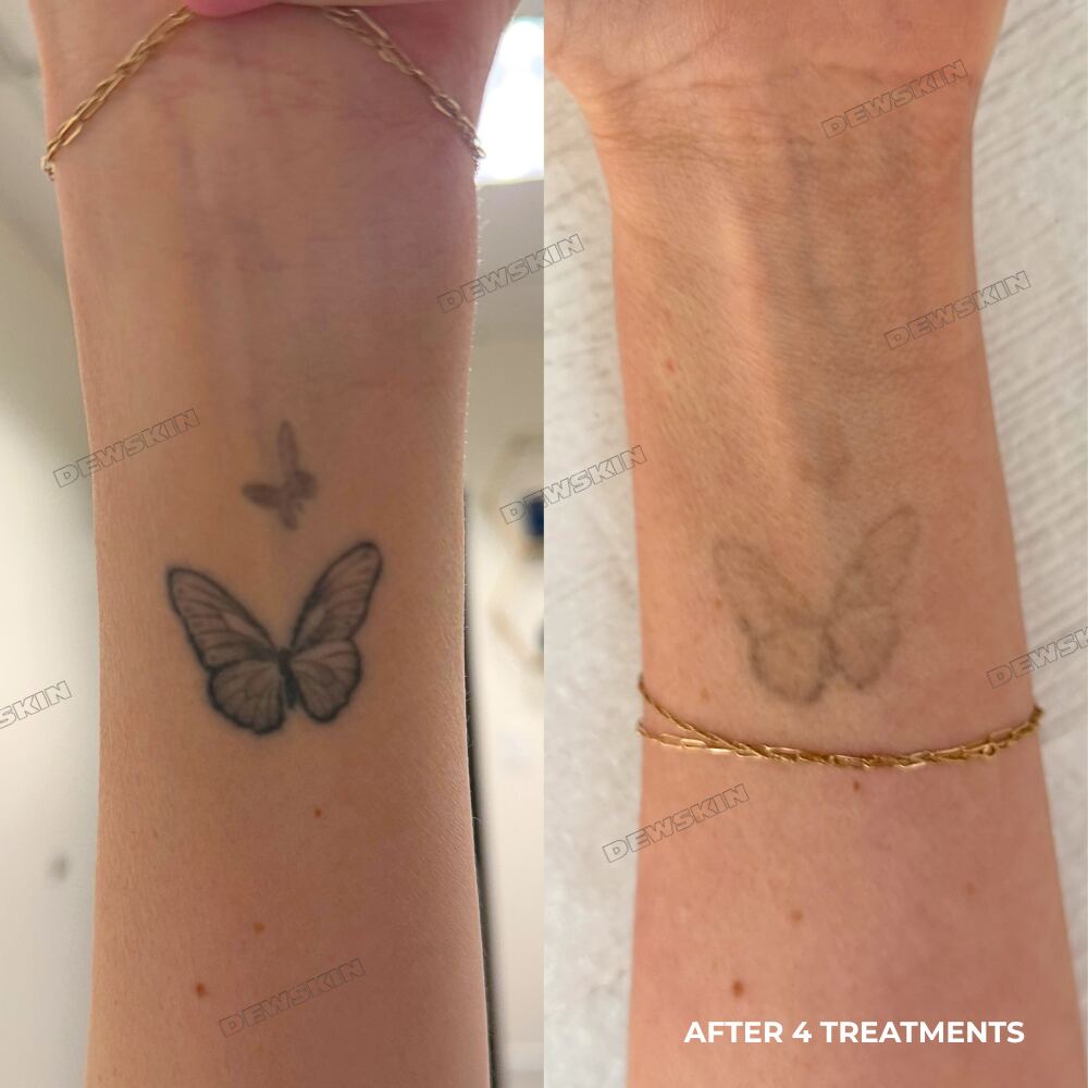 Tattoo removal before and after 3