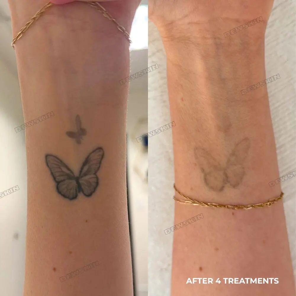Tattoo removal before and after 3