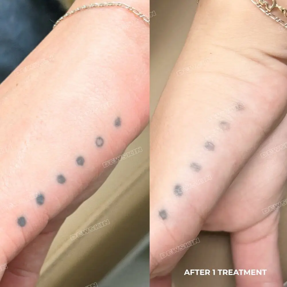 Tattoo removal before and after 1