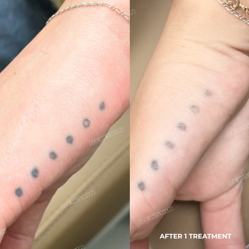 Tattoo removal before and after 1